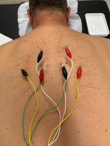 neuromodulation-and-electropunction-calvia-mallorca-dry-needles-mans-back